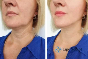 Double chin before and after Hi-Fu treatment 4 Book your double chin treatment Cambridge today! We are here to help!