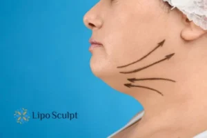 Double chin before and after Hi-Fu treatment 3 Boost your confidence with a Double chin treatment Cambridge