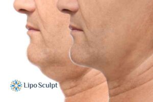 Double chin before and after Hi-Fu treatment 2 Double chin treatment Cambridge from Lipo Sculpt - feel more confident today!