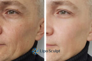 How to Fight Aging Symptoms 3 Fight Aging Symptoms Cambridge With HIFU and Morpheus8 Today!