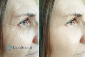 How to Fight Aging Symptoms 2 Do you want to Fight Aging Symptoms Cambridge? Contact Lipo Sculpt today!