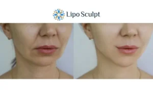 Explaining Total Skin Tightening Treatment And What It Can Do For You 2 Do you want to boost your self confidence? Give Morpheus8 Cambridge a try today!