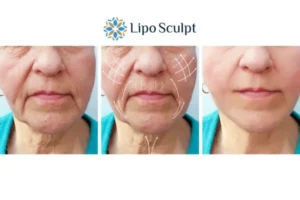 Explaining Total Skin Tightening Treatment And What It Can Do For You 3 Boost your confidence with Morpheus8 Cambridge call our team today!