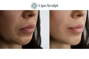 Explaining Total Skin Tightening Treatment And What It Can Do For You 4 Morpheus8 Cambridge the best results - call our team today!