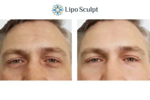Explaining Total Skin Tightening Treatment And What It Can Do For You 6 Morpheus8 Cambridge book in today to find out more!