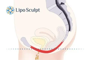 Pelvic Floor Chair Therapy 1 Pelvic Floor Chair Therapy Cambridge to treat incontinence.