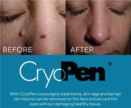image of angiofibroma removal Cambridge using Lipo Sculpt cryopen!